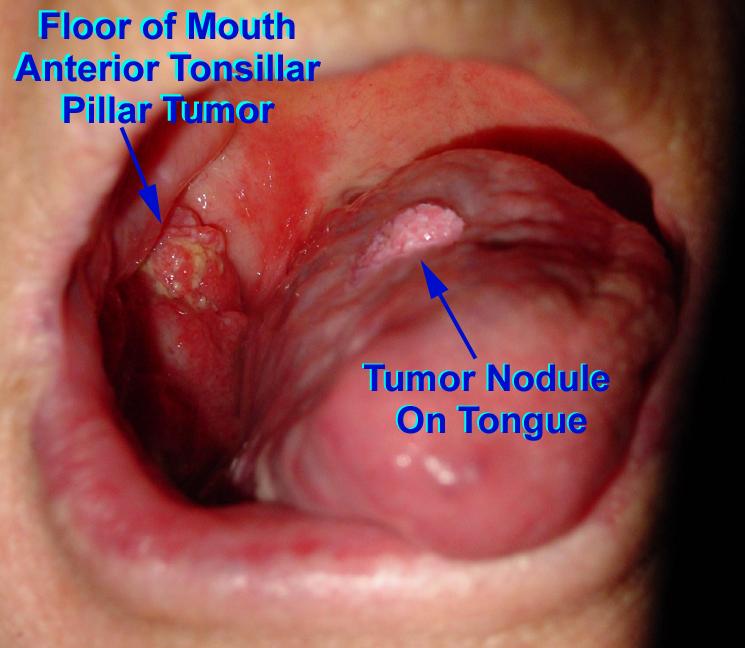 Squamous Cell Carcinoma of the Floor of Mouth and Tongue from Smoking and Tobacco