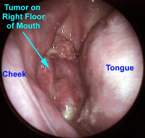 Floor of Mouth Cancer