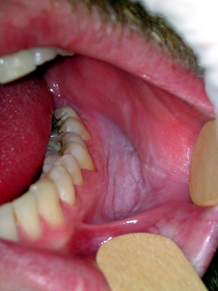 Oral Leukoplakia in the Gingival Buccal Sulcus From Chewing Tobacco
