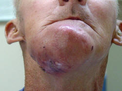 Oral Cancer Eroding Through Facial Skin