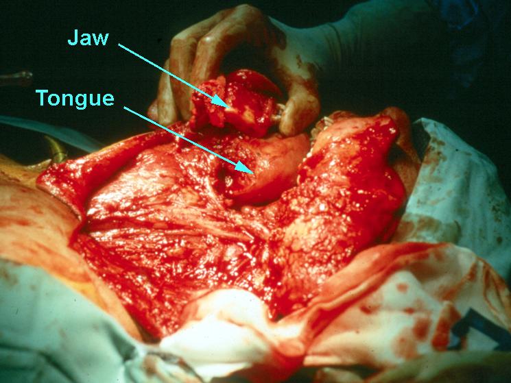 Commando Operation - Jaw-Tongue-Neck Resection During Surgery